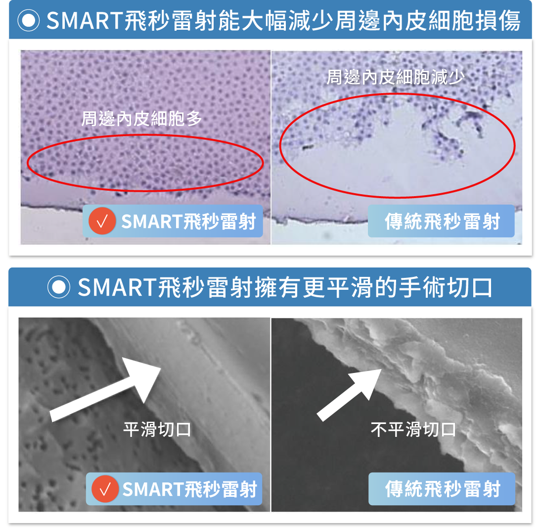 SMART飛秒雷射白內障優勢